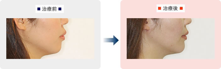 写真：矯正治療前後のお顔の変化